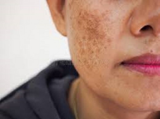 There are spots or freckles on the face