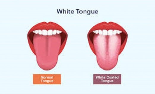 White layer on your tongue