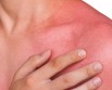 Are you also troubled by heat rash? 