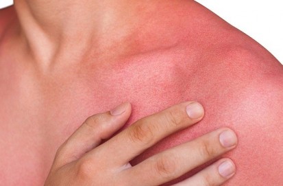 Are you also troubled by heat rash? 