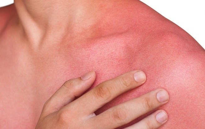Are you also troubled by heat rash? 