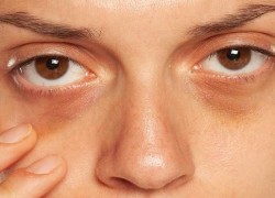 173650085023128-dark-circles-under-eyes.jpg