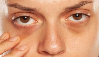 173650085023128-dark-circles-under-eyes.jpg