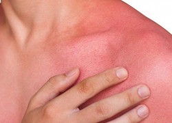 1747049432heat-rash-ft3.jpg
