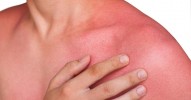 1747049432heat-rash-ft3.jpg